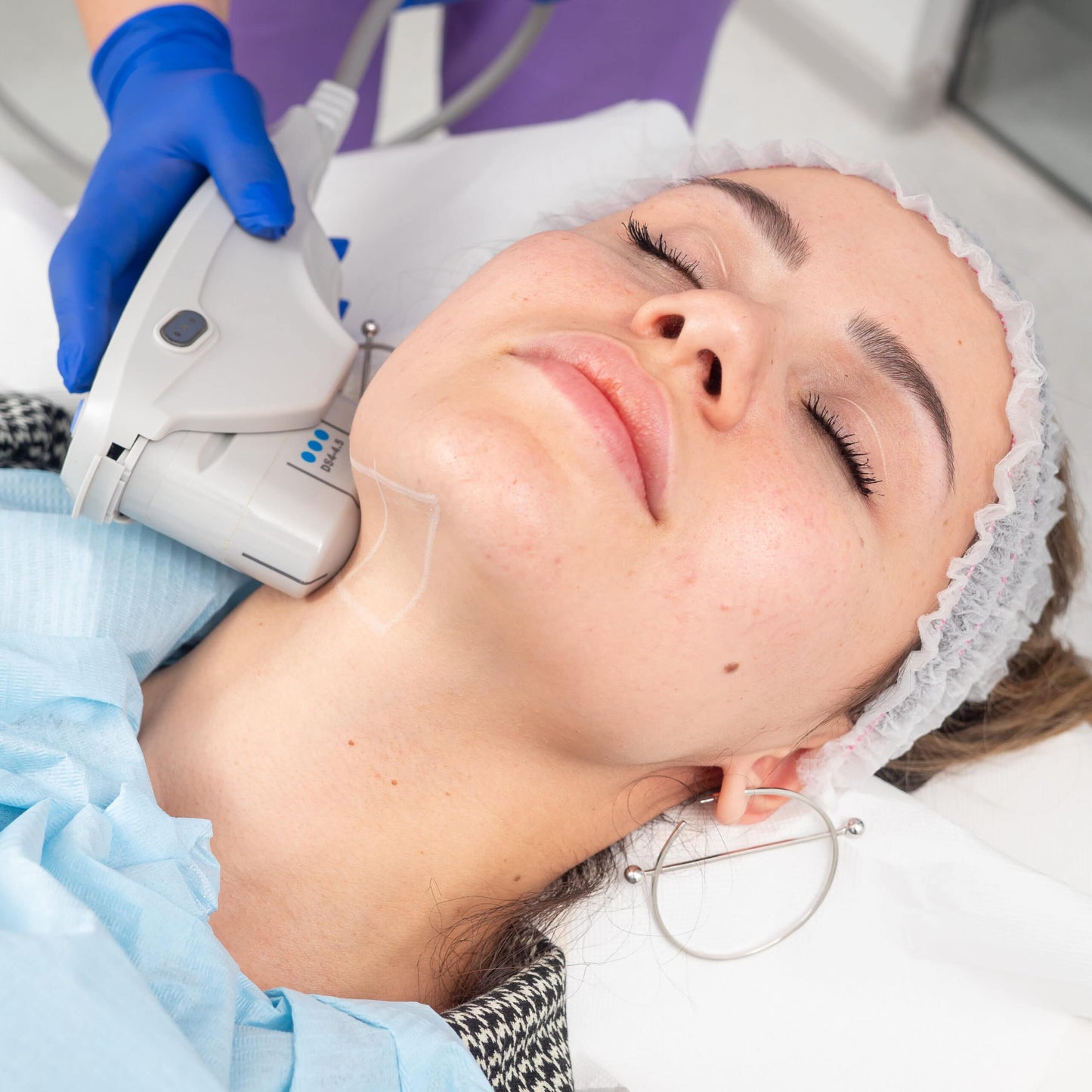 Tratament lifting facial noninvaziv FaceTight