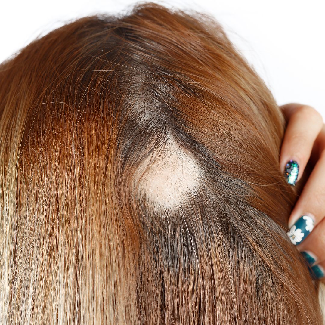 Test ADN anti-alopecie